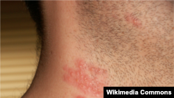 Bệnh zona (herpes-zoster, shingles)